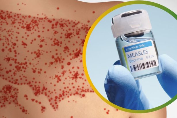 USA celia najhorsej epidemii osypok za 33 rokov
