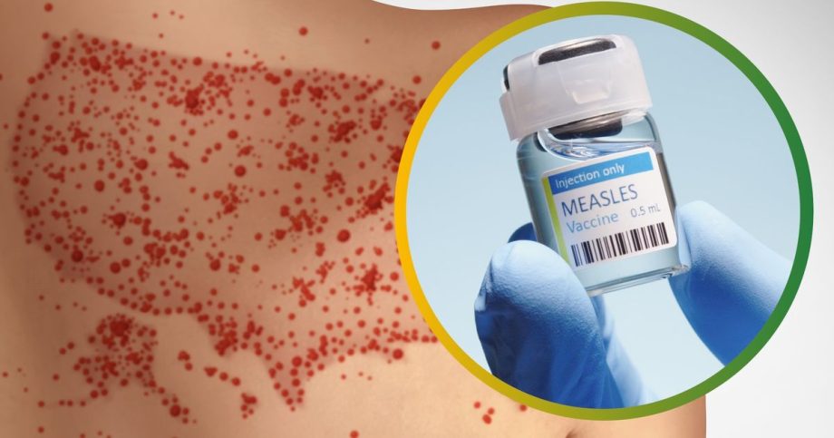 USA celia najhorsej epidemii osypok za 33 rokov